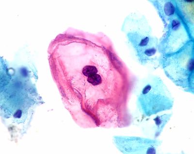 Pap stain, ThinPrep cervicovaginal cytology specimen; pink cell surrounded by blue cells on a white backgroun
