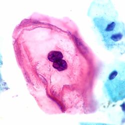 Pap stain, ThinPrep cervicovaginal cytology specimen; pink cell surrounded by blue cells on a white backgroun