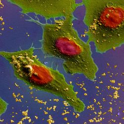  Lung cancer cells treated with nano sized drug carriers.