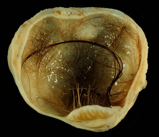 A mature cystic teratoma with hair inside A mature cystic teratoma with hair inside