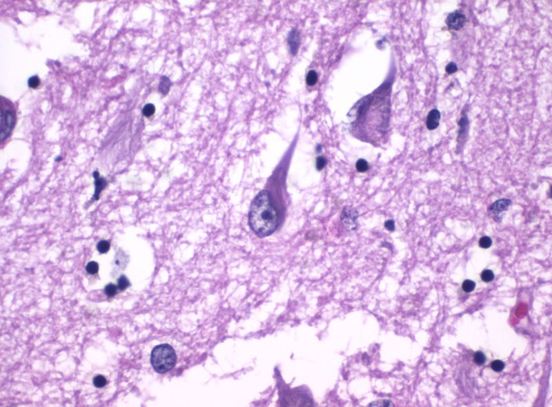 Histopathology of neurofibrillary tangles in the hippocampus in Alzheimer's disease. H&E stain.