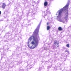 Histopathology of neurofibrillary tangles in the hippocampus in Alzheimer's disease. H&E stain.