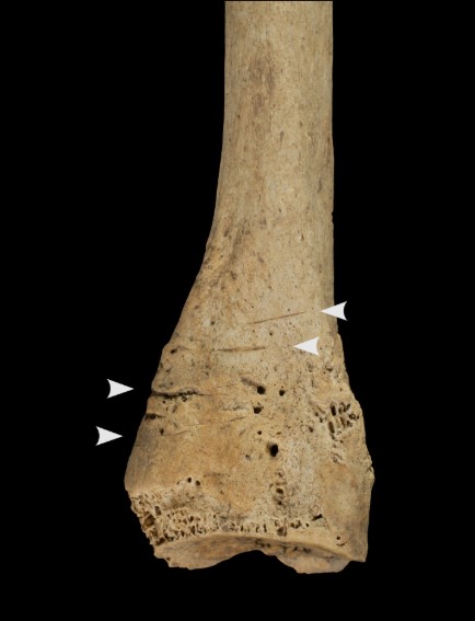 A human bone butchered by cannibals A human bone butchered by cannibals