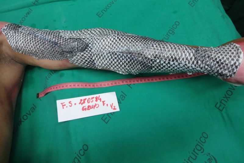 Tilapia skin graft