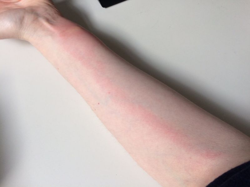 lymphangitis on forearm