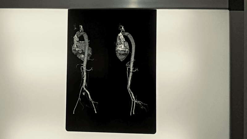 CTA (CT-Scan angiography) whole aorta 