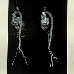 CTA (CT-Scan angiography) whole aorta 